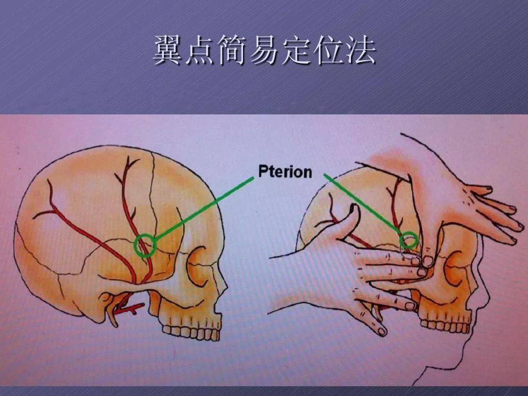 pterion翼点解剖及入路