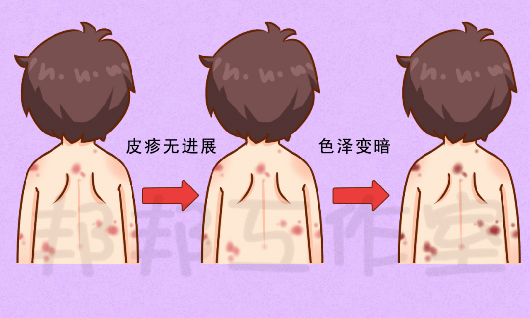 婴童突然全身出现红色的瘀点是怎么回事