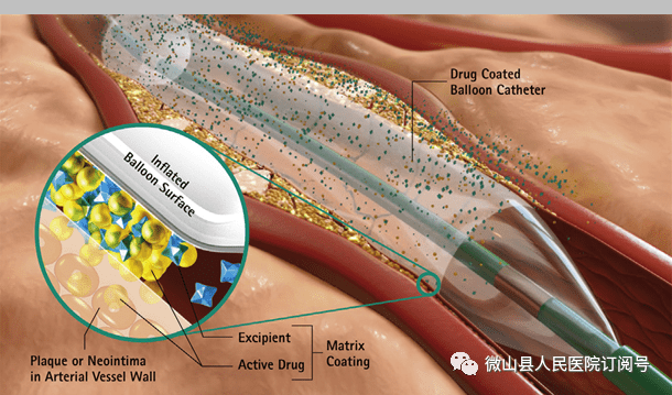 介入无植入微山县人民医院心内二科成功开展药物球囊治疗冠心病新技术