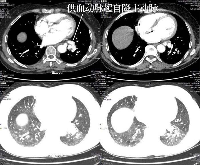 一起来了解肺隔离症 ct 影像表现