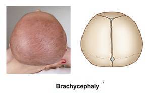 当通过睡头型导致后脑勺平平的,颅骨变成这个样子:平平的后脑勺,在
