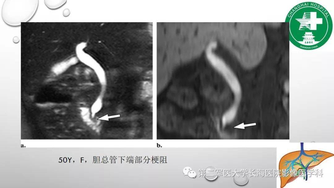 普美显丨肝胆特异性MRI对比剂-钆塞酸二钠Gd-EOB-DTPA-搜狐大视野-搜狐新闻
