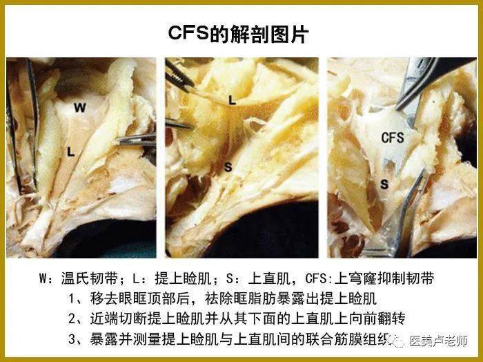 结膜上穹窿联合筋膜鞘(cfs)悬吊术