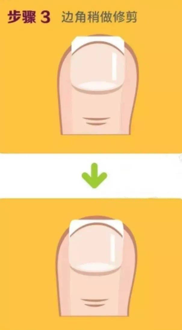 指甲剪不对带来大麻烦这才是剪指甲的正确方法