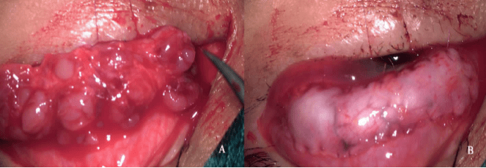 张明昌教授异体唇腺移植重度干眼治疗的新曙光