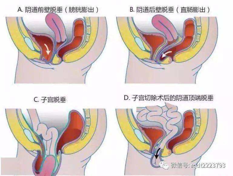 盆底器官脱垂:会阴部有下坠感,子宫脱垂,阴道前壁膨出(膀胱膨出),阴道