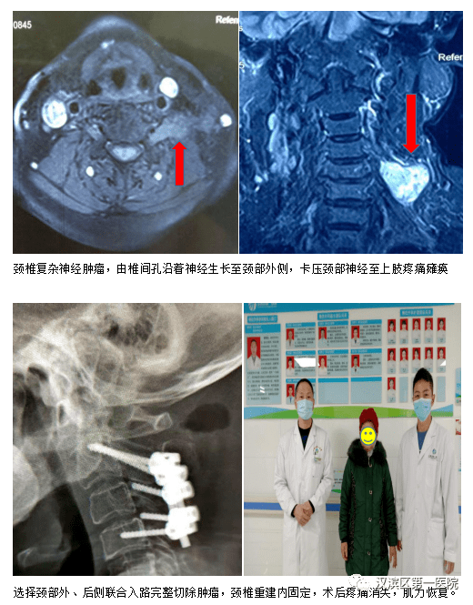 我院成功开展上颈椎损伤手术和复杂颈髓肿瘤手术