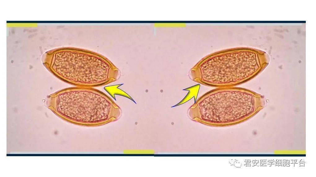 鞭虫卵显微镜下图图片