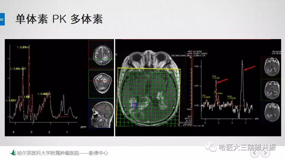 磁共振波谱成像(mrs)的原理及临床应用