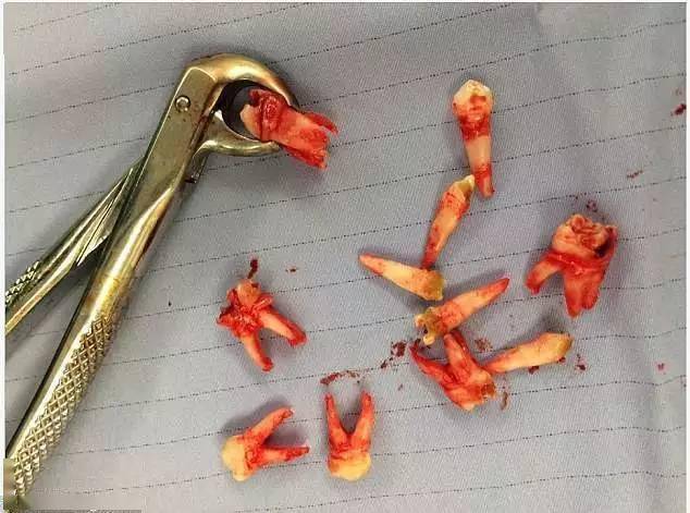 牙医不得不给人们看看这些恐怖的照片