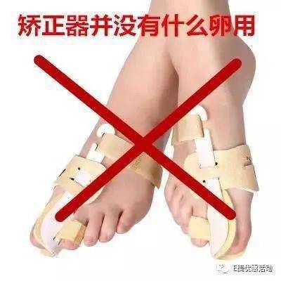 宋茜左脚大拇指被挤得通红右脚更是明显变形严重的外翻