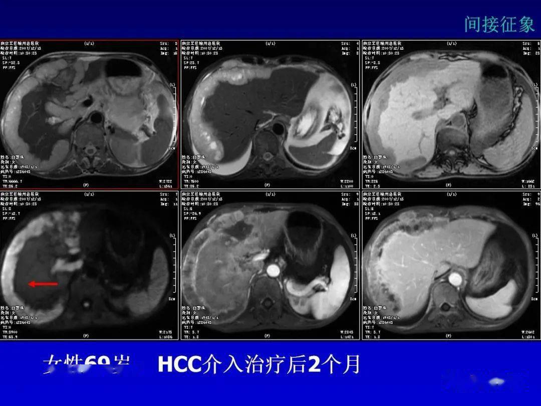 肝细胞肝癌hcc与胆管细胞癌icc影像诊断要点