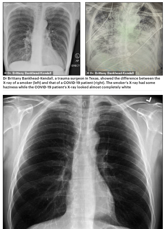 新冠肺部片子图片