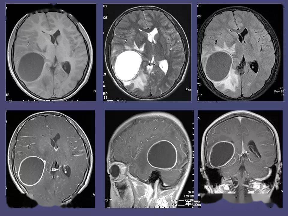 收藏脑内常见环形强化疾病的疾病诊断