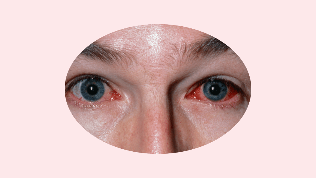 但是病毒感染可能导致病毒性结膜炎,然后我们的眼睛可能就会变红