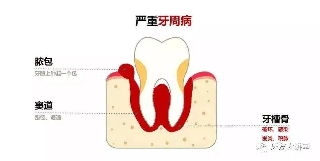 【牙周炎】正在殺死95%中國人的