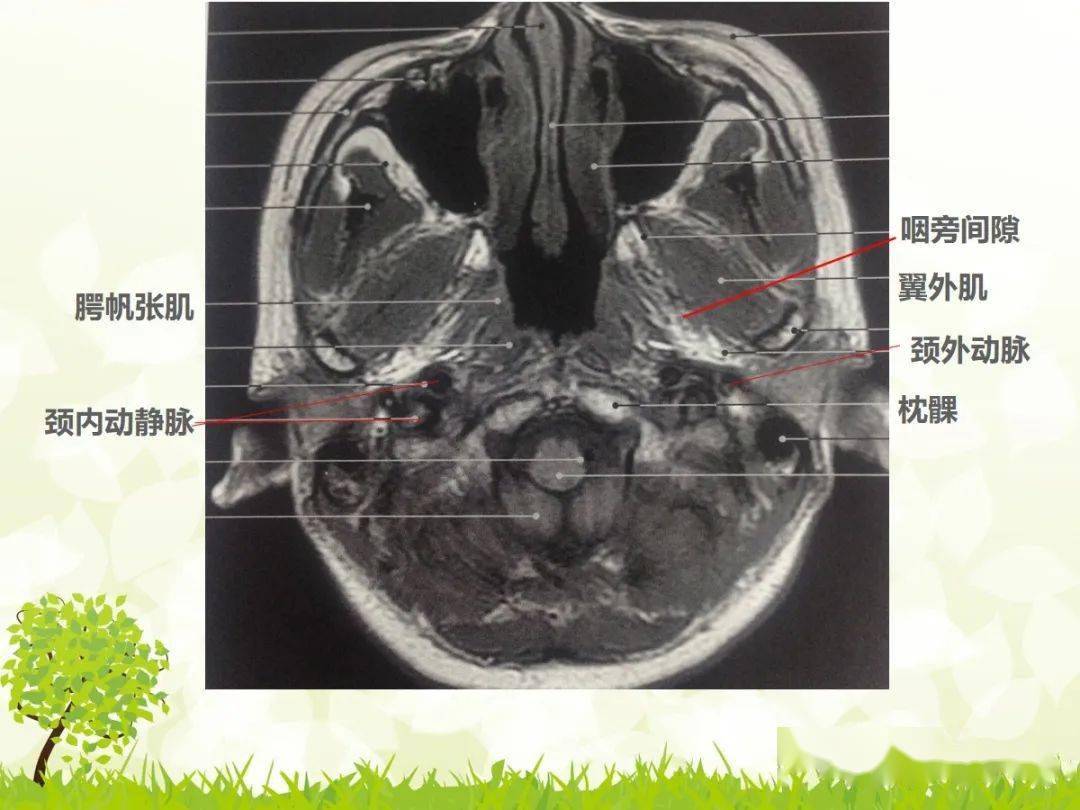 咽隐窝ct解剖图图片