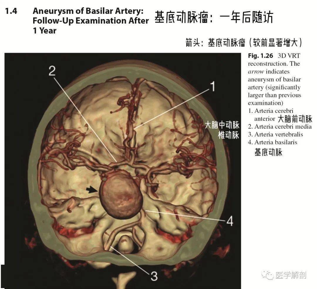 头颅血管cta解剖图谱ppt图片