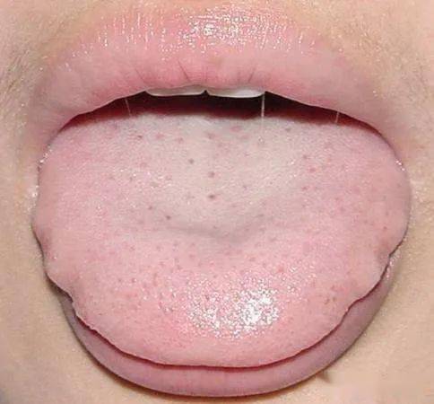 气虚体质舌苔图片图片