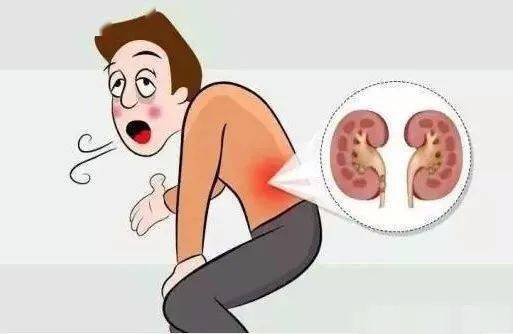 腰疼是不是结石还在输尿管 820852433d164a36a8eabf1532ae887e.jpeg