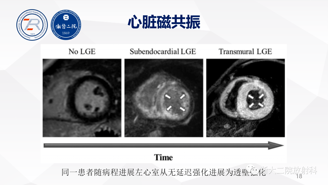心脏淀粉样变性影像表现