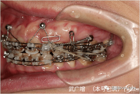 严重深覆合锁合成人矫治案例