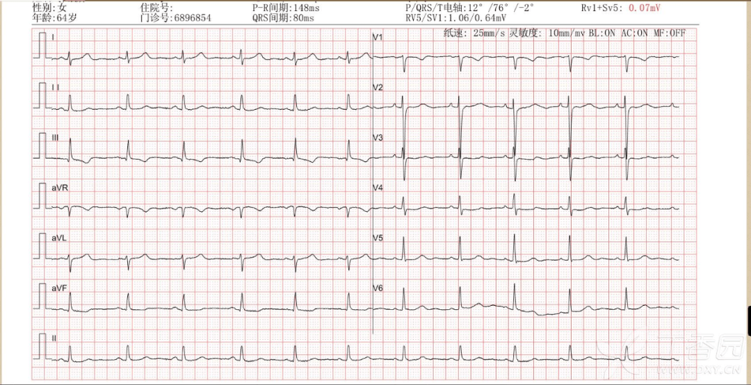心电图rv5和sv1的范围图片