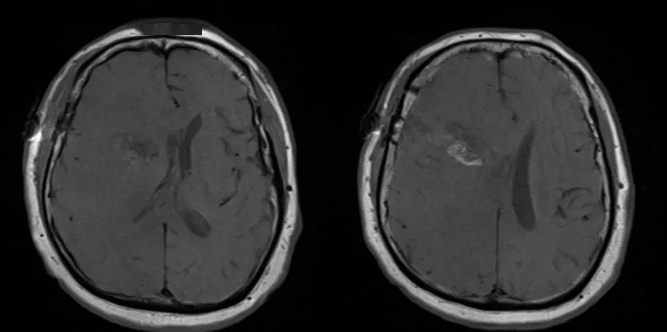 平扫mri轴位t1相上可见手术通道及填充其内的止血纱.