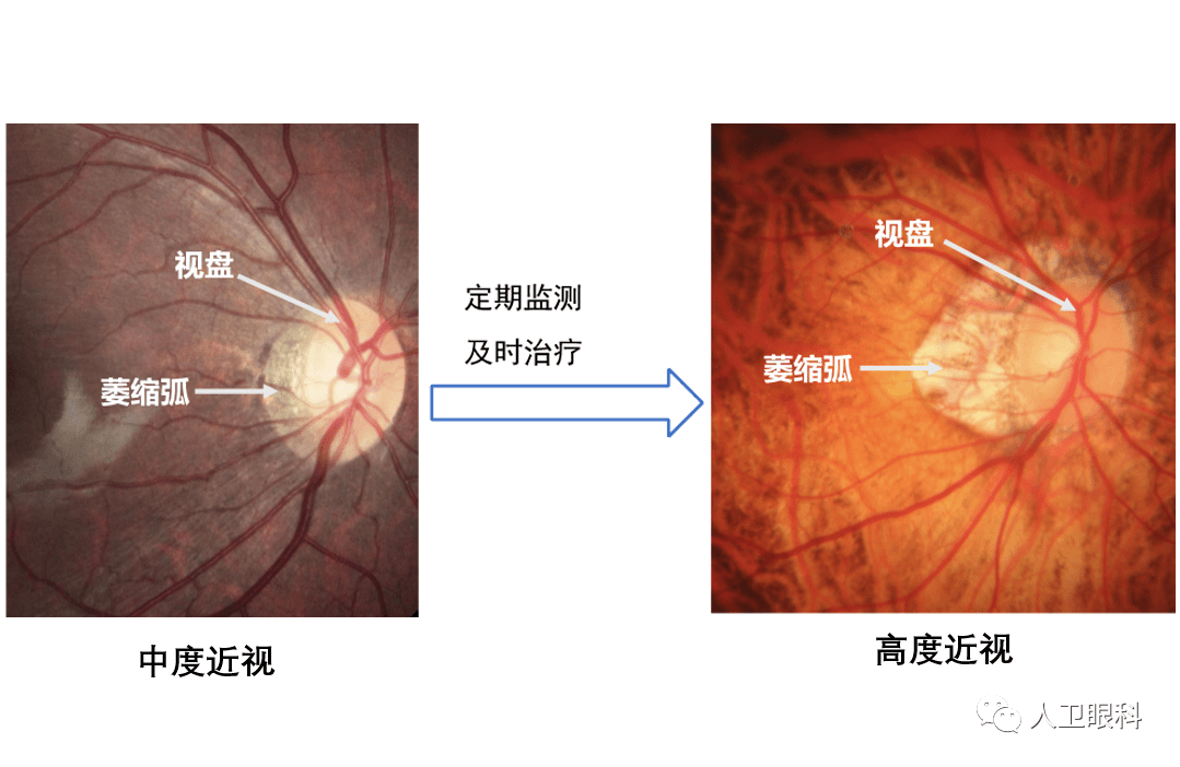 眼底近视弧图图片