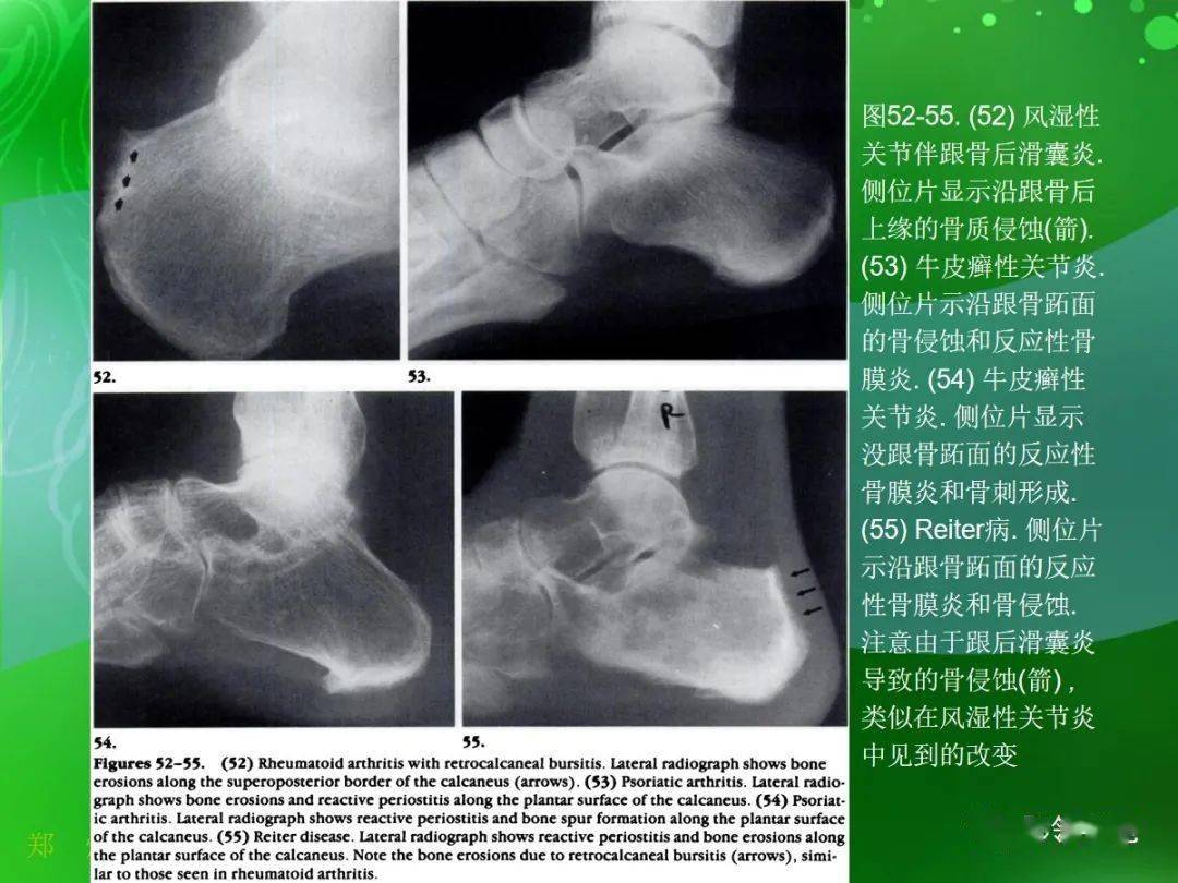 侵蚀(图56)罕见骨内钙化性痛风石—附丽病(enthesopathy)在跟骨韧带