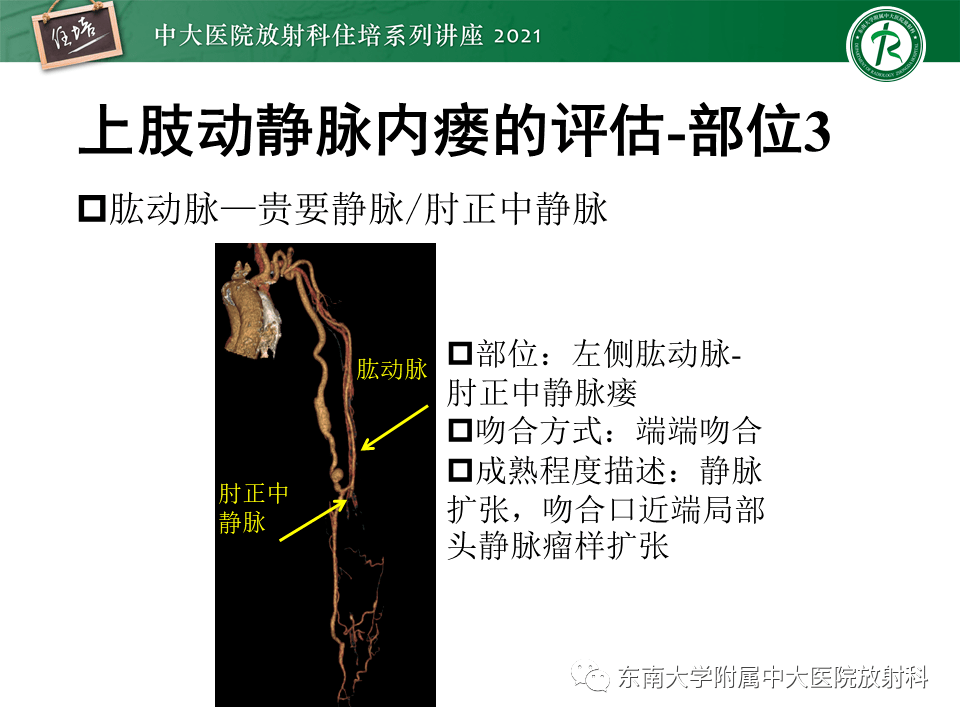 中大放射住培系列讲座上肢动静脉解剖及人工动静脉造瘘术后cta影像