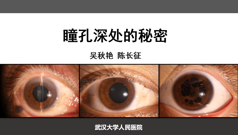 吴秋艳医生分享了她在临床轮转时遇到的一例单眼瞳孔散大病例