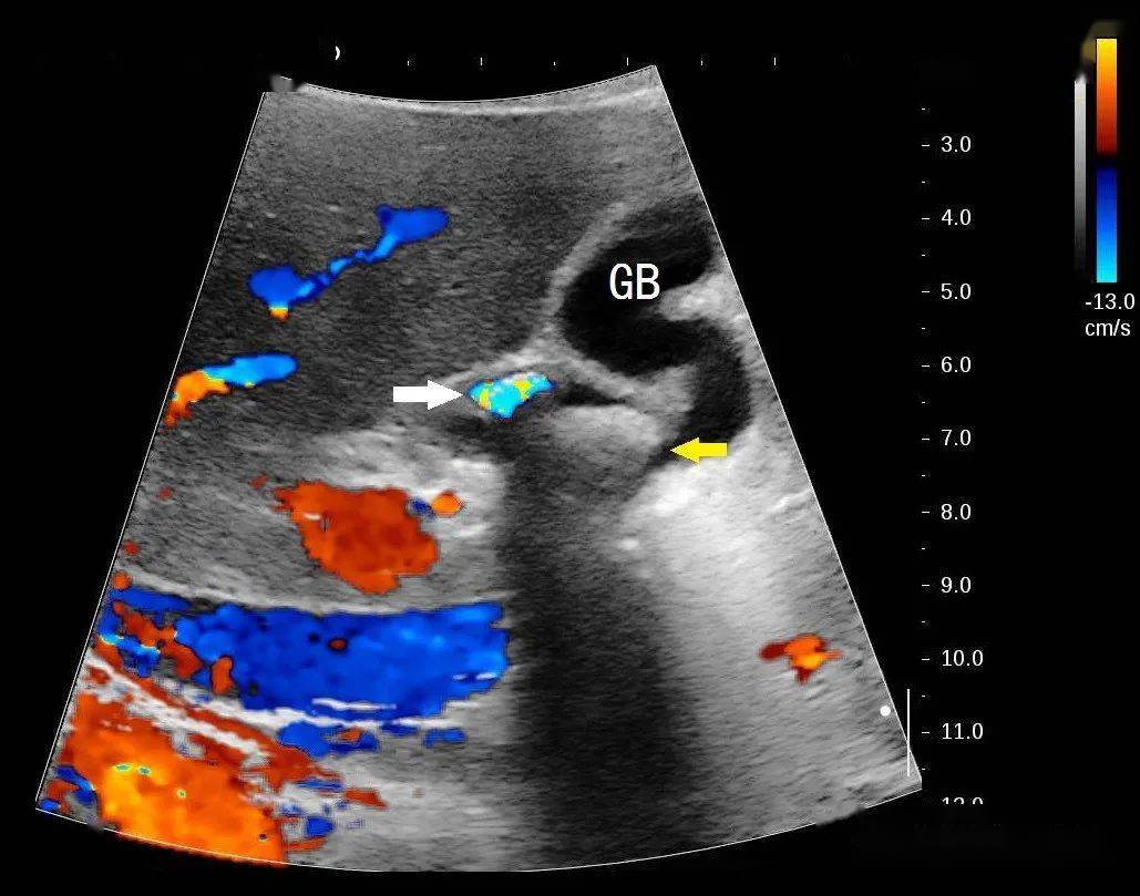图2 两块结石的彩色多普勒所见.