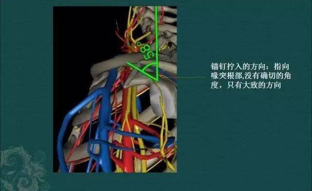 內固定可以維持鎖骨與喙突間的正常位置,待喙鎖韌帶修復後取出螺釘