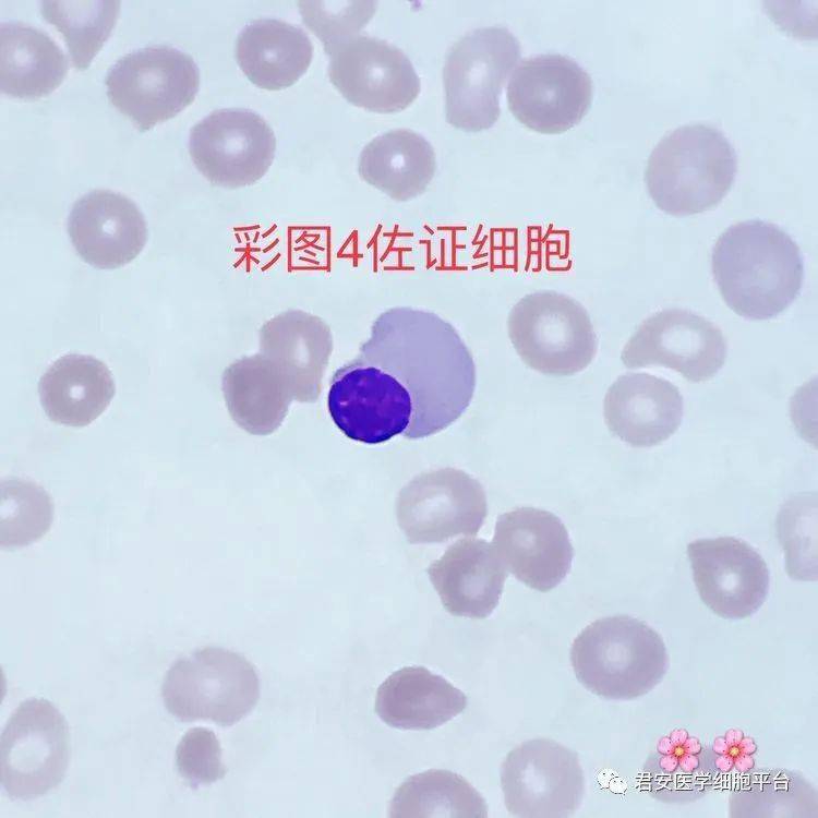 核染色质致密,聚集呈一个紫黑色团块,碳核是晚幼红细胞脱核后的产物