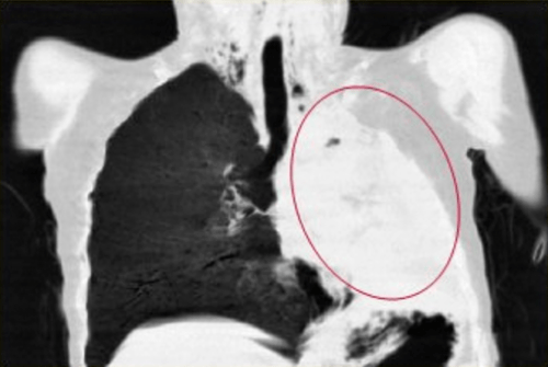 咳嗽 6 天，左肺「消失」了？