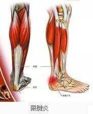 阿基里斯之痛 跟腱炎的病因与保护 运动