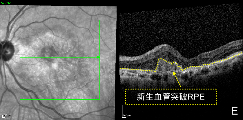 和 bvn(黄色圆圈内)icga