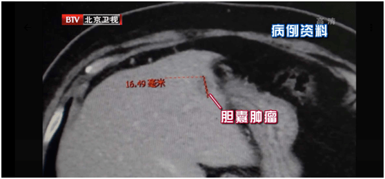 多年结石不重视 最终变成癌 身体里的各种结石 到底该怎么消除 看完就明白了 胆汁