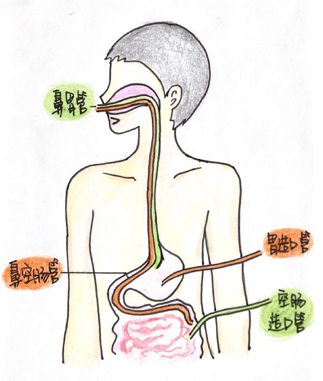 三腔鼻空肠管图片