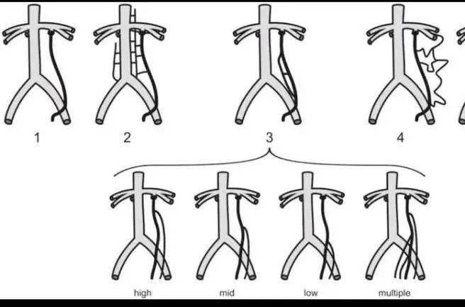 精索静脉曲张泡沫硬化剂栓塞术及术后随访情况