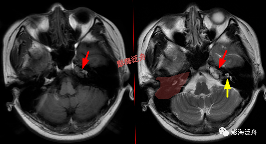 颅骨病变脑膜炎患者,桥前池内可见异常增多的血管影(红箭),正常人的桥
