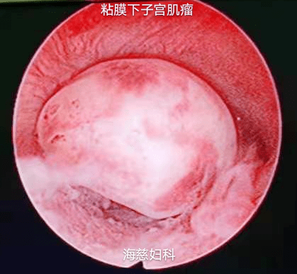 子宫粘膜下肌瘤图片