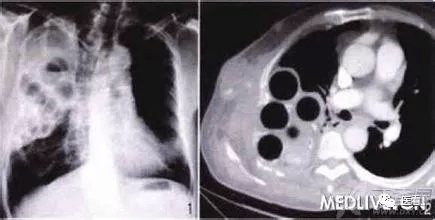 内衣与胸片_dr胸片穿了内衣(3)