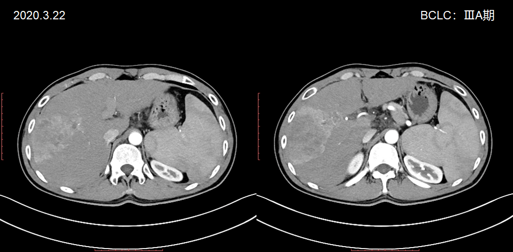肝癌的磁共振影像图片图片