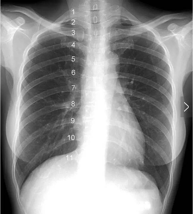胸片正常肺部就正常吗？