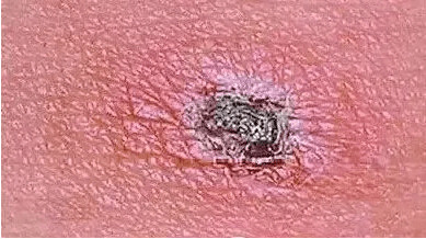 恙虫病东方体是一种革兰氏阴性,专性胞内细菌,属变形菌纲α亚群立克次