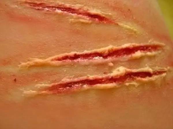 红药水 兑水牙签掺一点粉底液进去白乳胶搅合皮开肉绽效果图二,割伤