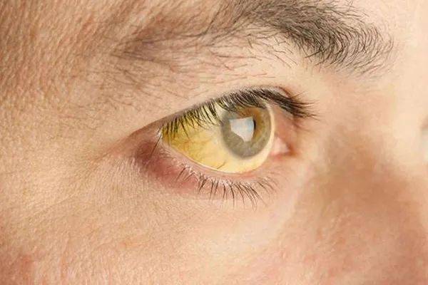 这是比较典型的肝病症状,如果发现自己眼白发黄,皮肤暗黄严