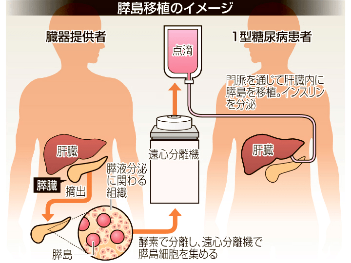 日本將用胰島移植治療Ⅰ型糖尿病計劃用再生醫療解決供體不足的問題